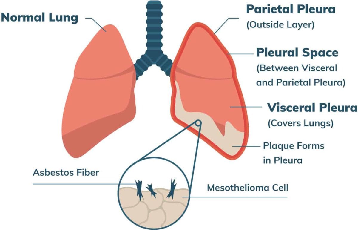 Facts About Malignant Mesothelioma