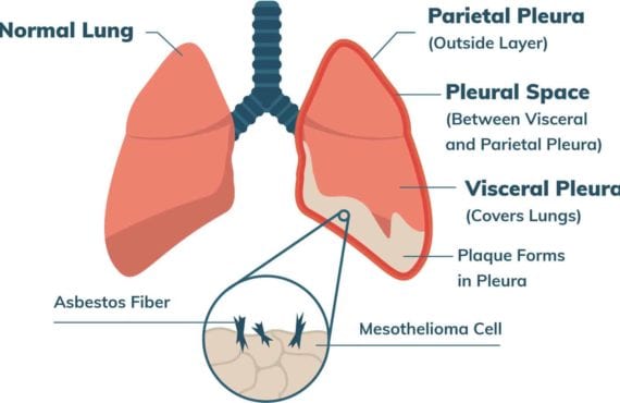 Facts About Malignant Mesothelioma